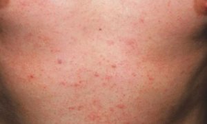 Pityrosporum Folliculitis - Treatment, Symptoms, Pictures, Cure